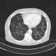 Chondrohamartoma of lung, ground-glass: CT - Computed tomography